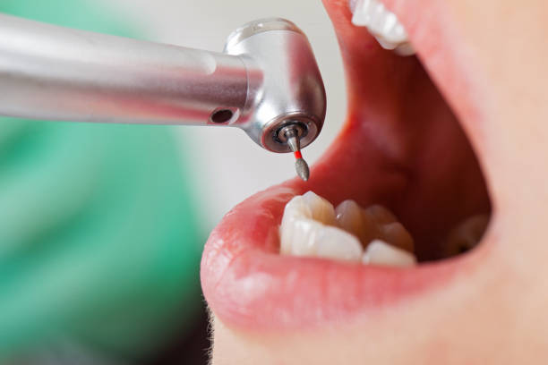 Best Emergency Root Canal Treatment in Wellsville, OH